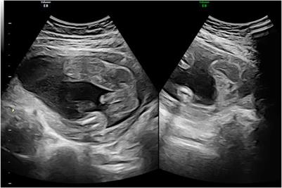 Case report: A pregnant woman accidental treated with spironolactone in mid-gestation